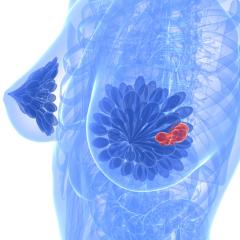Fine-tuning treatment for triple-negative breast cancer