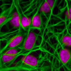 Research suggests calcium movement in cells goes awry in both breast cancers and metastatic tumours in the brain