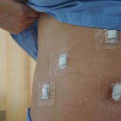 Abdomen of a patient who has had laparoscopic surgery