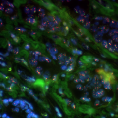 Hotspot mutations in breast cancer genomes identified 